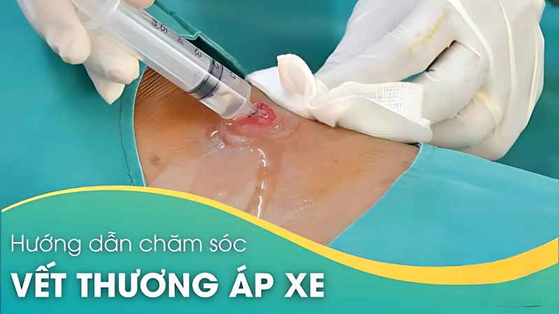 Khi bị áp xe phải làm gì cần thăm khám và điều trị kịp thời