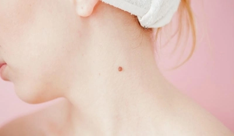 Giải mã đoán tính cách và vận mệnh qua nốt ruồi ở cổ