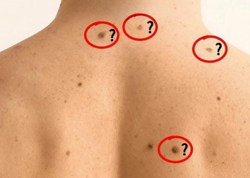 Giải mã nốt ruồi trên lưng có ý nghĩa gì về tướng số