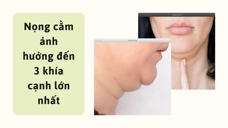 Nọng cằm ảnh hưởng đến 3 khía cạnh lớn nhất